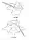 Fig. 12 - In-situ formed intervertebral fusion device and method