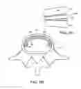 Fig. 15 - In-situ formed intervertebral fusion device and method