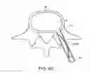 Fig. 16 - In-situ formed intervertebral fusion device and method