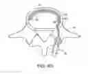 Fig. 17 - In-situ formed intervertebral fusion device and method