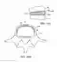 Fig. 18 - In-situ formed intervertebral fusion device and method