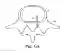 Fig. 21 - In-situ formed intervertebral fusion device and method