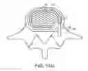 Fig. 23 - In-situ formed intervertebral fusion device and method