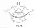 Fig. 27 - In-situ formed intervertebral fusion device and method