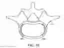 Fig. 28 - In-situ formed intervertebral fusion device and method