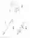 Fig. 03 - Instruments and methods for removing fixation devices from intervertebral implants