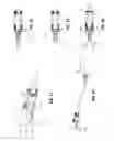 Fig. 08 - Instruments and methods for removing fixation devices from intervertebral implants