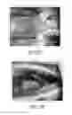 Fig. 16 - Porous bidirectional bellowed tracheal reconstruction device