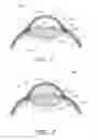 Fig. 02 - Minimally invasive glaucoma surgical instrument and method