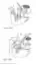 Fig. 09 - Minimally invasive glaucoma surgical instrument and method