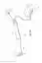 Fig. 33 - Minimally invasive glaucoma surgical instrument and method