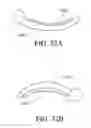 Fig. 35 - Minimally invasive glaucoma surgical instrument and method