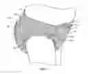 Fig. 07 - Absorbent articles with pulpless riffled core