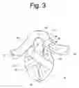 Fig. 04 - Modular, deformable, cushioned, resistive infant positioning system and method