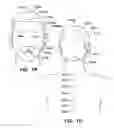 Fig. 03 - Implantable electroacupuncture system and method for treating depression and similar mental conditions