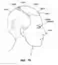 Fig. 23 - Implantable electroacupuncture system and method for treating depression and similar mental conditions