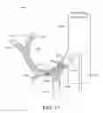 Fig. 18 - Methods of modulating nerves of the hepatic plexus