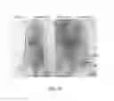 Fig. 15 - METHODS OF TREATMENT OF KERATINOCYTE-DERIVED LESIONS
