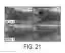 Fig. 22 - METHODS OF TREATMENT OF KERATINOCYTE-DERIVED LESIONS