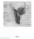 Fig. 11 - Method of treating disease by auricular anesthesia of cranial nerves