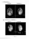 Fig. 06 - Methods for treating antipsychotic-induced weight gain