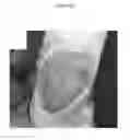 Fig. 22 - for the treatment of solid tumors in humans