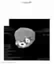 Fig. 25 - for the treatment of solid tumors in humans