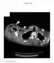Fig. 33 - for the treatment of solid tumors in humans