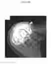Fig. 34 - for the treatment of solid tumors in humans