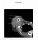 Fig. 45 - for the treatment of solid tumors in humans