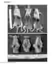 Fig. 06 - Suppression of cancer metastasis
