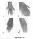 Fig. 14 - Methods for treating pain by topical application and transdermal delivery of botulinum toxin