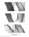 Fig. 20 - Methods for treating pain by topical application and transdermal delivery of botulinum toxin