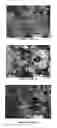 Fig. 11 - Shapeable bone graft substitute and instruments for delivery thereof