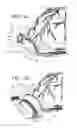 Fig. 14 - Ventricular cuff