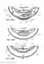 Fig. 41 - Ventricular cuff