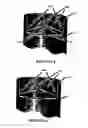 Fig. 06 - Nebulizer device and mask of inhalation solution