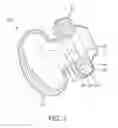 Fig. 03 - Nasal prong and patient interface device including the same