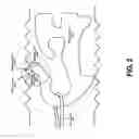 Fig. 03 - ADJUSTING A POSITION OF A HEATING WIRE WITHIN A BREATHING CIRCUIT