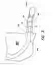 Fig. 03 - Stabilizing and sealing catheter for use with a guiding catheter