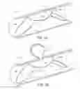 Fig. 03 - Partial Circumferential Stent With Non-Radial Apposition