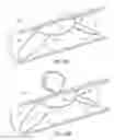 Fig. 03 - Partial Circumferential Stent With Non-Radial Apposition