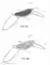 Fig. 07 - Partial Circumferential Stent With Non-Radial Apposition