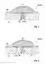 Fig. 02 - Medical implant with a fixing device