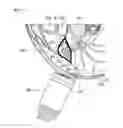 Fig. 10 - Devices and methods for non-invasive capacitive electrical stimulation and their use for vagus nerve stimulation on the neck of a patient