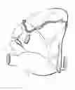 Fig. 10 - Intra cardiac device, system and methods