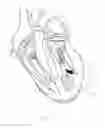 Fig. 14 - Intra cardiac device, system and methods