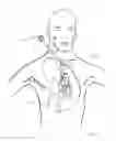 Fig. 23 - Intra cardiac device, system and methods