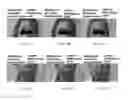 Fig. 18 - Esthetic apparatus useful for increasing skin rejuvenation and methods thereof