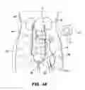Fig. 42 - System and method for optogenetic therapy